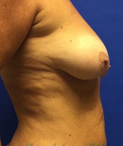 Breast Lift case #4235