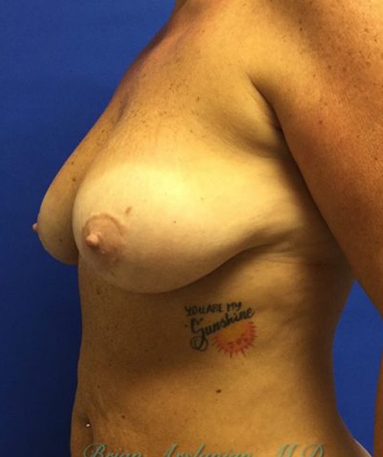 Breast Lift case #4235