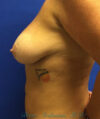 Breast Lift case #4235