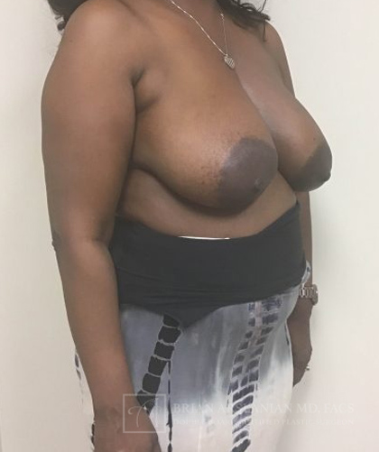 Breast Lift case #4382