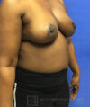 Breast Lift case #4382