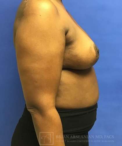 Breast Lift case #4382