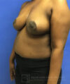 Breast Lift case #4382