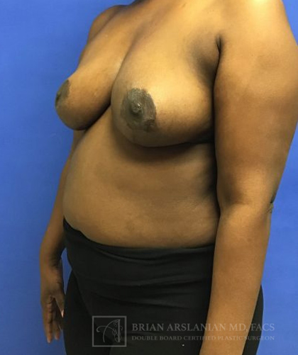 Breast Lift case #4382