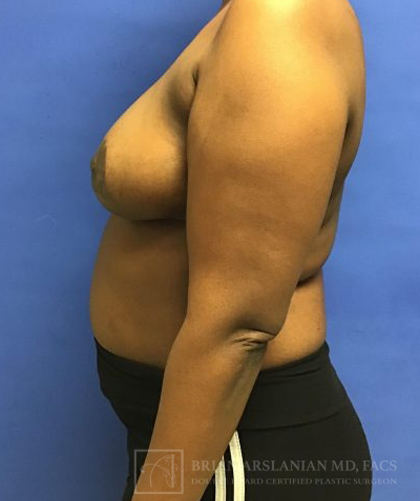 Breast Lift case #4382