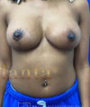 Breast Lift case #4386