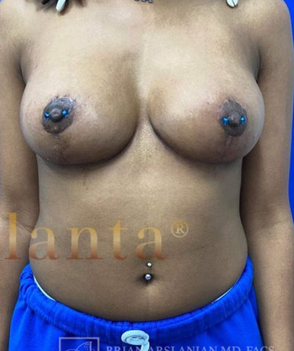 Breast Lift case #4386