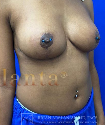 Breast Lift case #4386