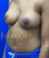 Breast Lift case #4386