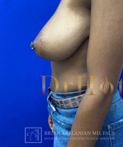 Breast Lift case #4386