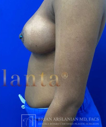 Breast Lift case #4386