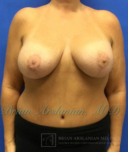Breast Lift case #4379