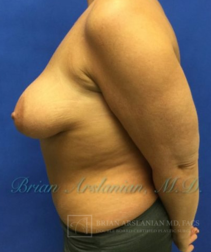 Breast Lift case #4379