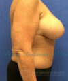 Breast Lift case #4379