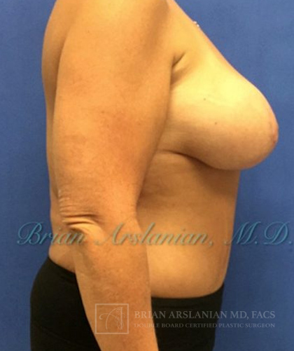 Breast Lift case #4379