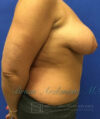 Breast Lift case #4379