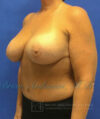 Breast Lift case #4379