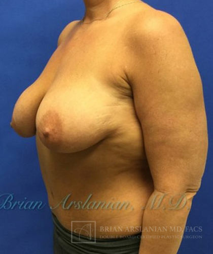 Breast Lift case #4379