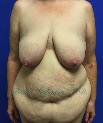 Breast Lift case #4381