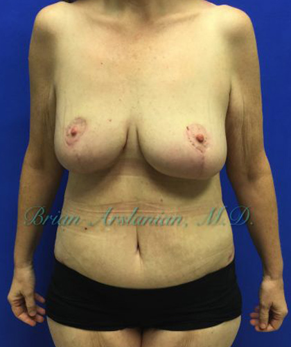 Breast Lift case #4381