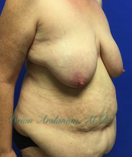 Breast Lift case #4381