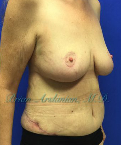 Breast Lift case #4381