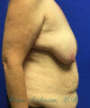 Breast Lift case #4381