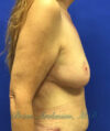 Breast Lift case #4381