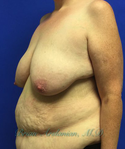 Breast Lift case #4381