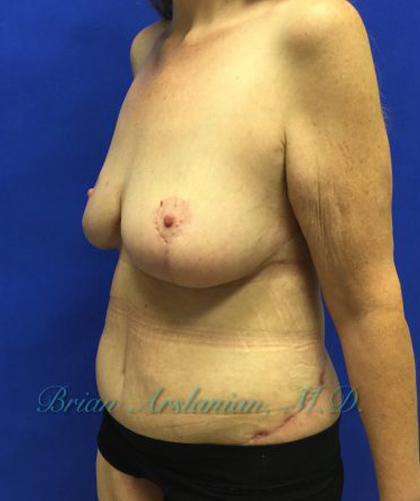 Breast Lift case #4381