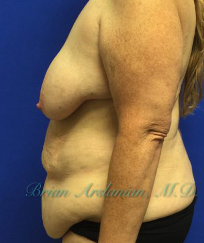 Breast Lift case #4381