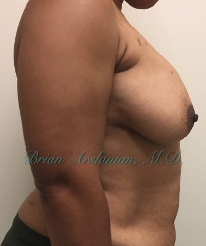 Breast Lift case #4380