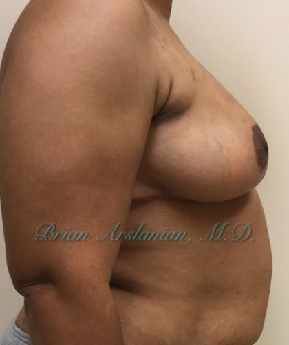 Breast Lift case #4380