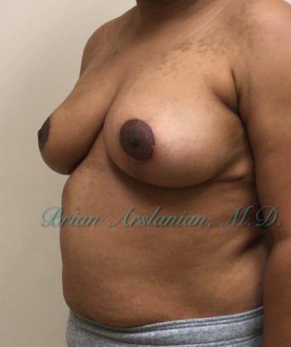 Breast Lift case #4380