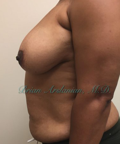 Breast Lift case #4380