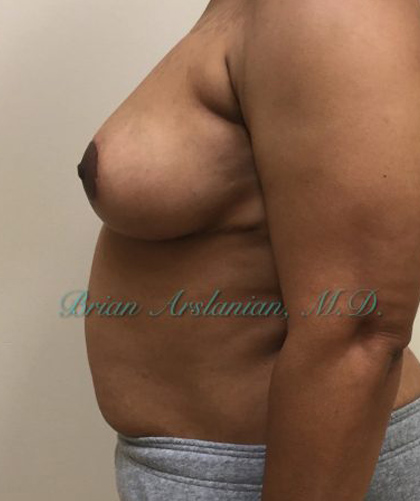 Breast Lift case #4380