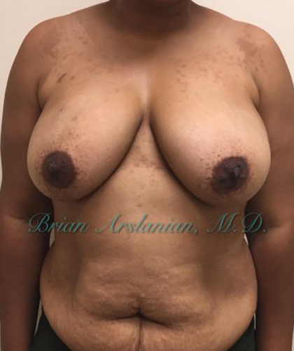 Breast Lift case #4380