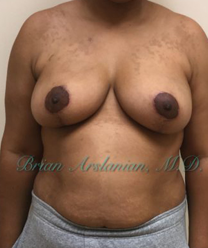 Breast Lift case #4380