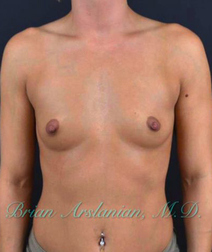 Breast Augmentation case #2520