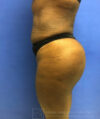 Liposuction case #3605