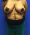 Breast Reduction case #2912