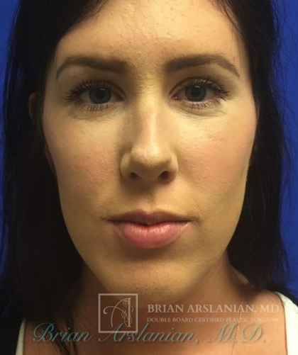 Chin Implant case #2780