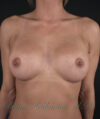 Breast Augmentation case #2520