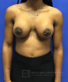 Breast Implants and Lift case #3014