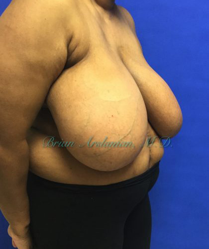 Breast Reduction case #2912