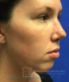 Chin Implant case #2780