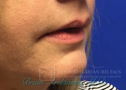 Fillers case #3484