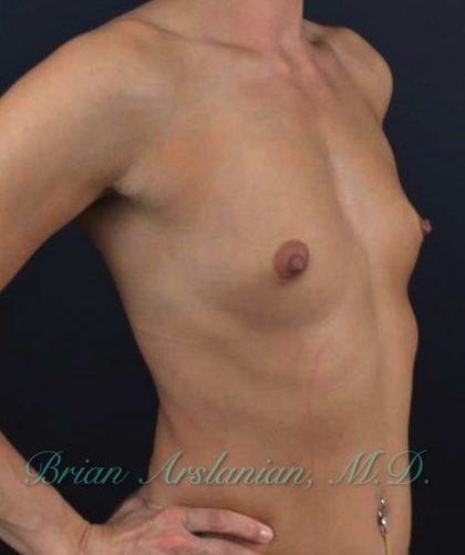 Breast Augmentation case #2520