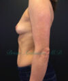 Breast Augmentation case #2522