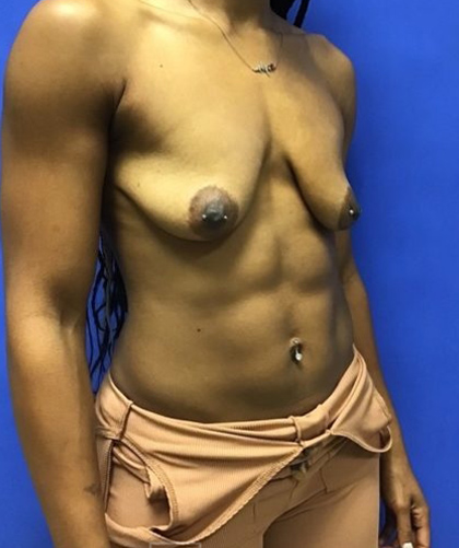 Breast Implants and Lift case #3014